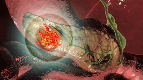 Microorganisms in Tumors May Help Identify New Approaches for Treating Pancreatic Cancer.
