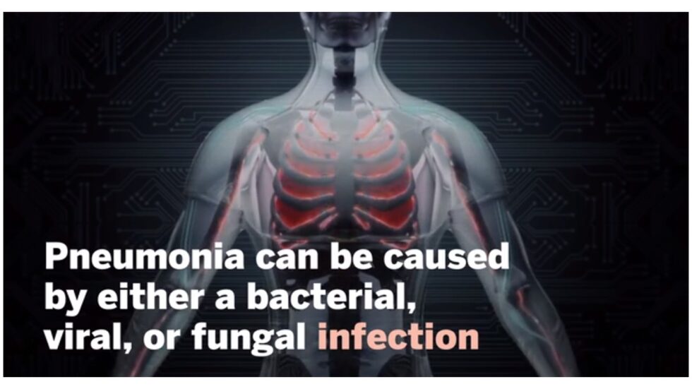 is-pneumonia-contagious-what-to-know-and-how-to-protect-yourself